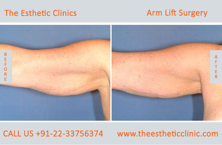 Arm Lift Surgery, Brachioplasty before after photos in mumbai india (6)